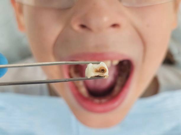 Best Emergency Tooth Extraction in Pecan Grove, TX